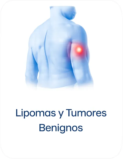 Lipomas o bolitas de grasa