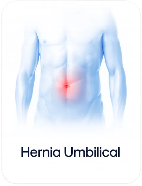 Hernia umbilical